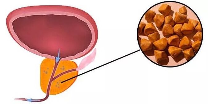 Pierres de la prostate